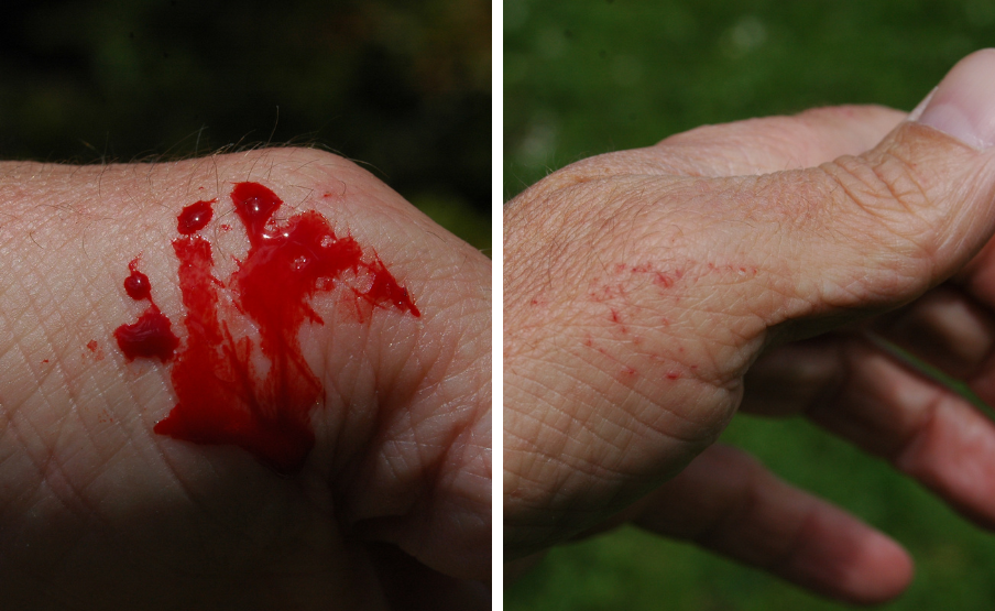 A haragossiklók harapásnyoma látványos lehet, de csak felszínes. A fognyomok közvetlenül a harapás után, majd néhány perccel később, kézmosást követően. (Kép: Babocsay Gergely)